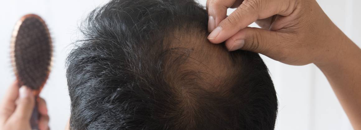 Mi okozza a haj elvékonyodását és a hajhullást?