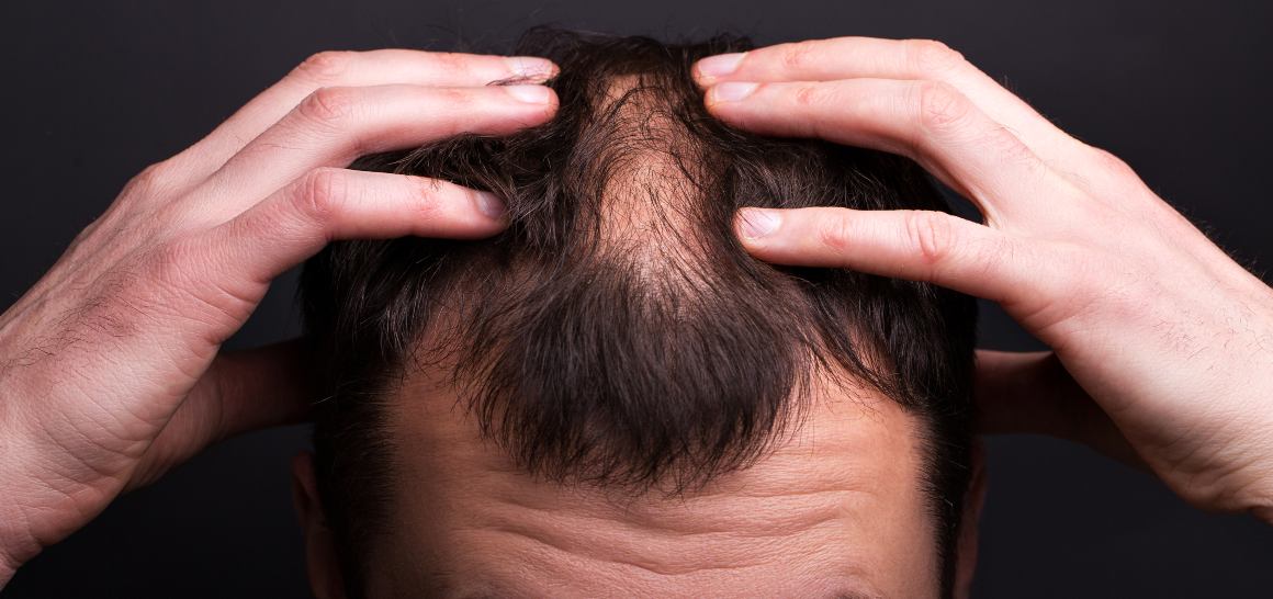 A CBD olaj segíthet a haj növekedésében?