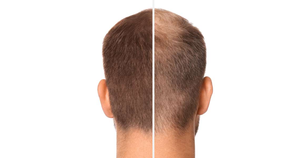 Segíti az Omega-3 a haj növekedését?